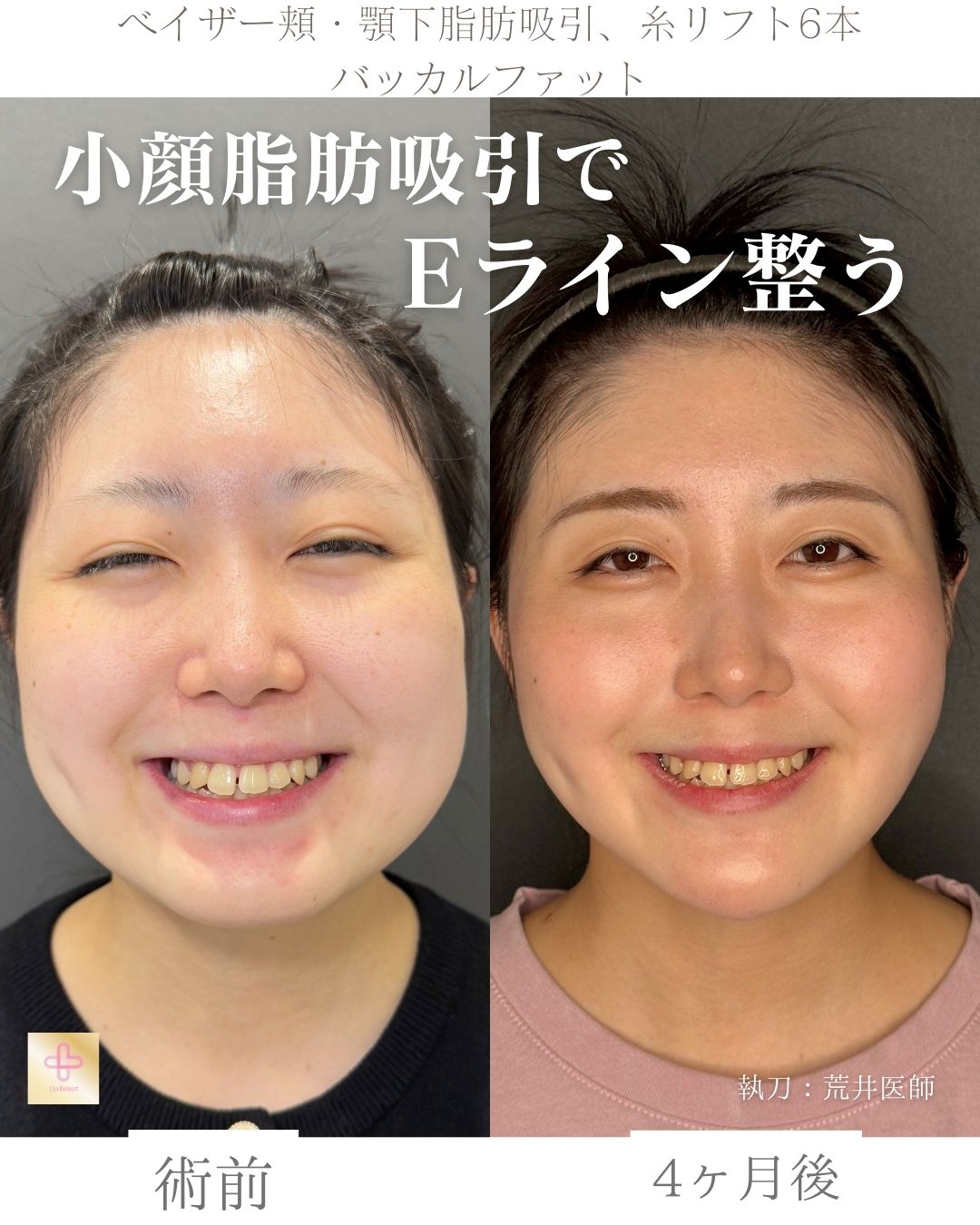 小顔脂肪吸引、バッカルファット、糸リフト