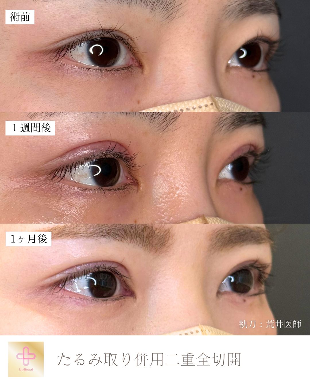 たるみ取り併用全切開二重術