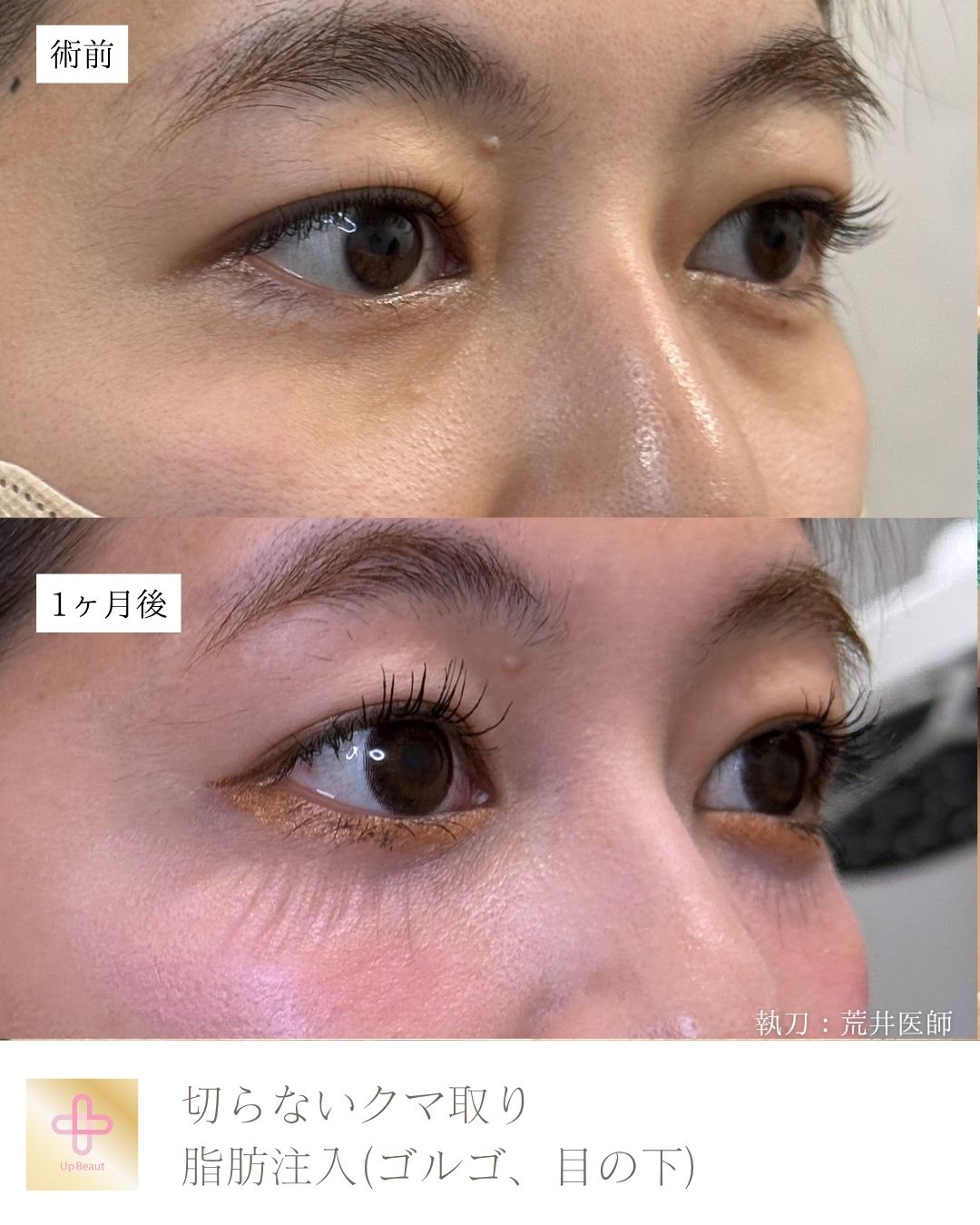 目の下の脱脂、脂肪注入（目の下）