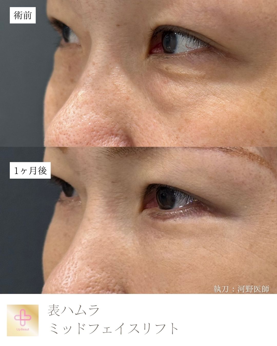 表ハムラ法 ・ミッドフェイスリフト