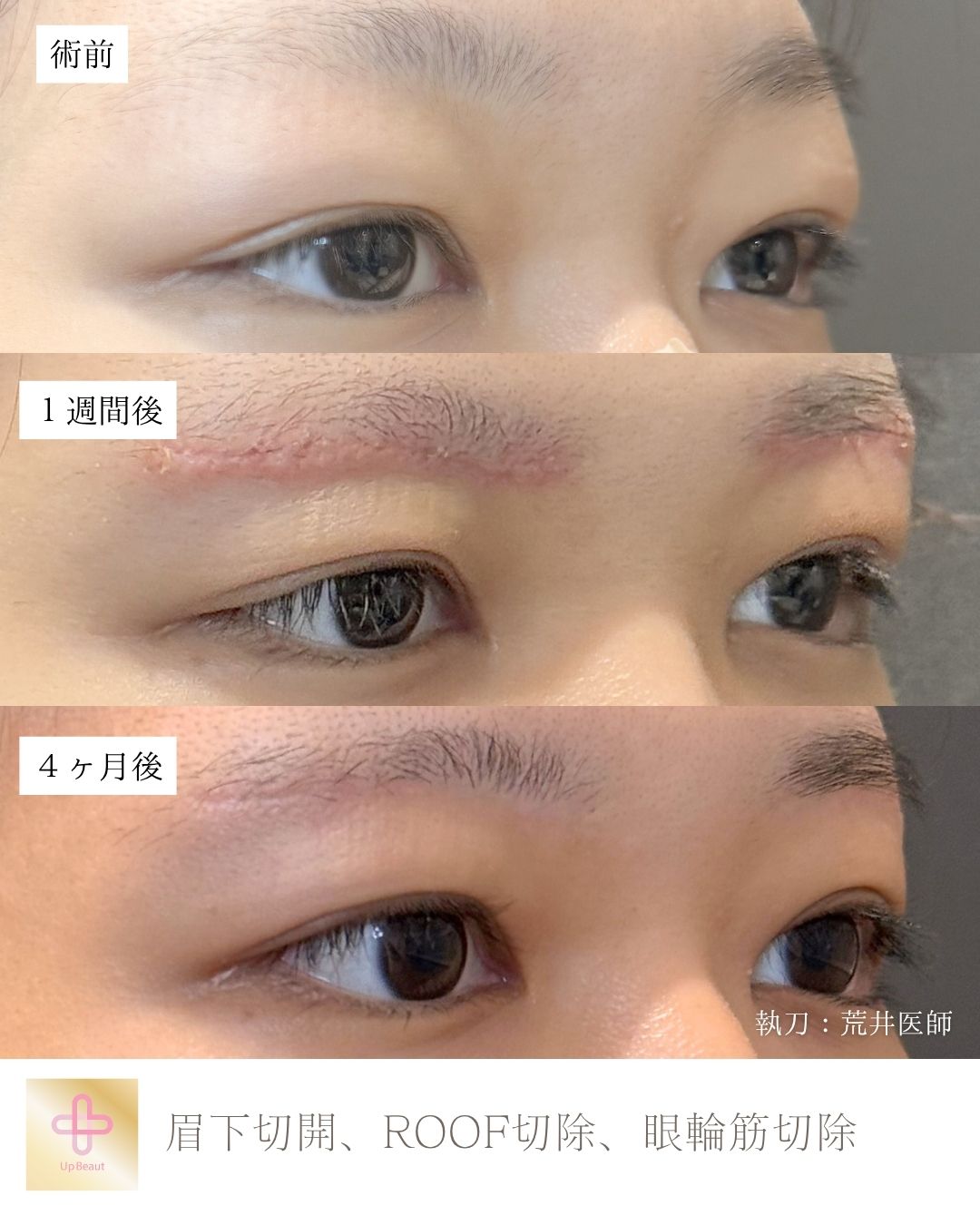 眉下切開、ROOF切除、眼輪筋切除