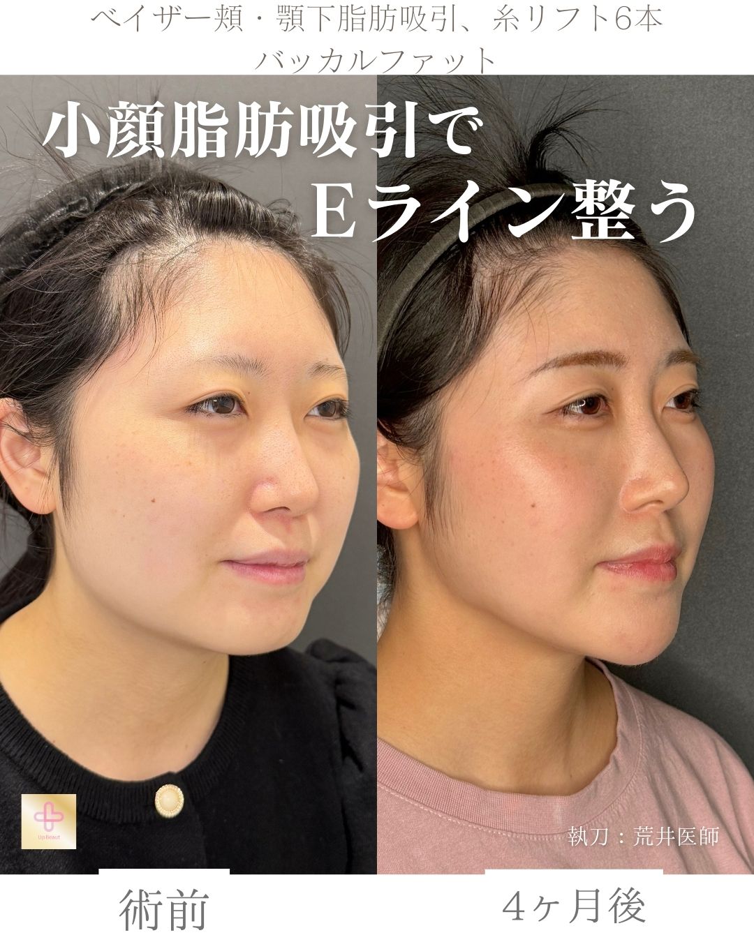 小顔脂肪吸引、バッカルファット、糸リフト