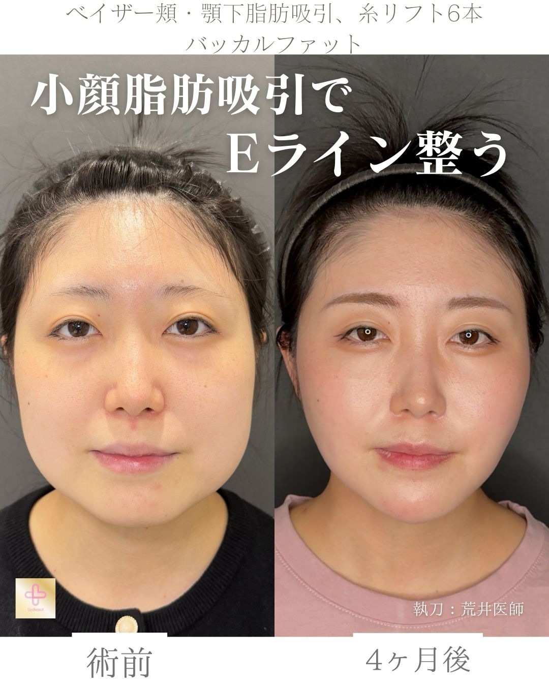 小顔脂肪吸引、バッカルファット、糸リフト