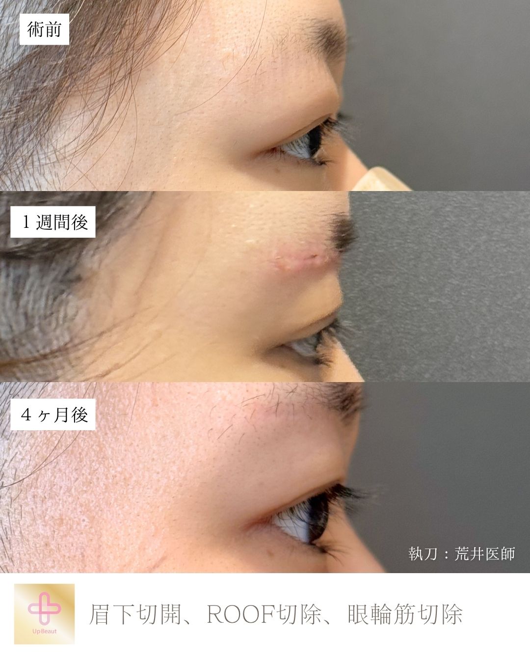 眉下切開、ROOF切除、眼輪筋切除