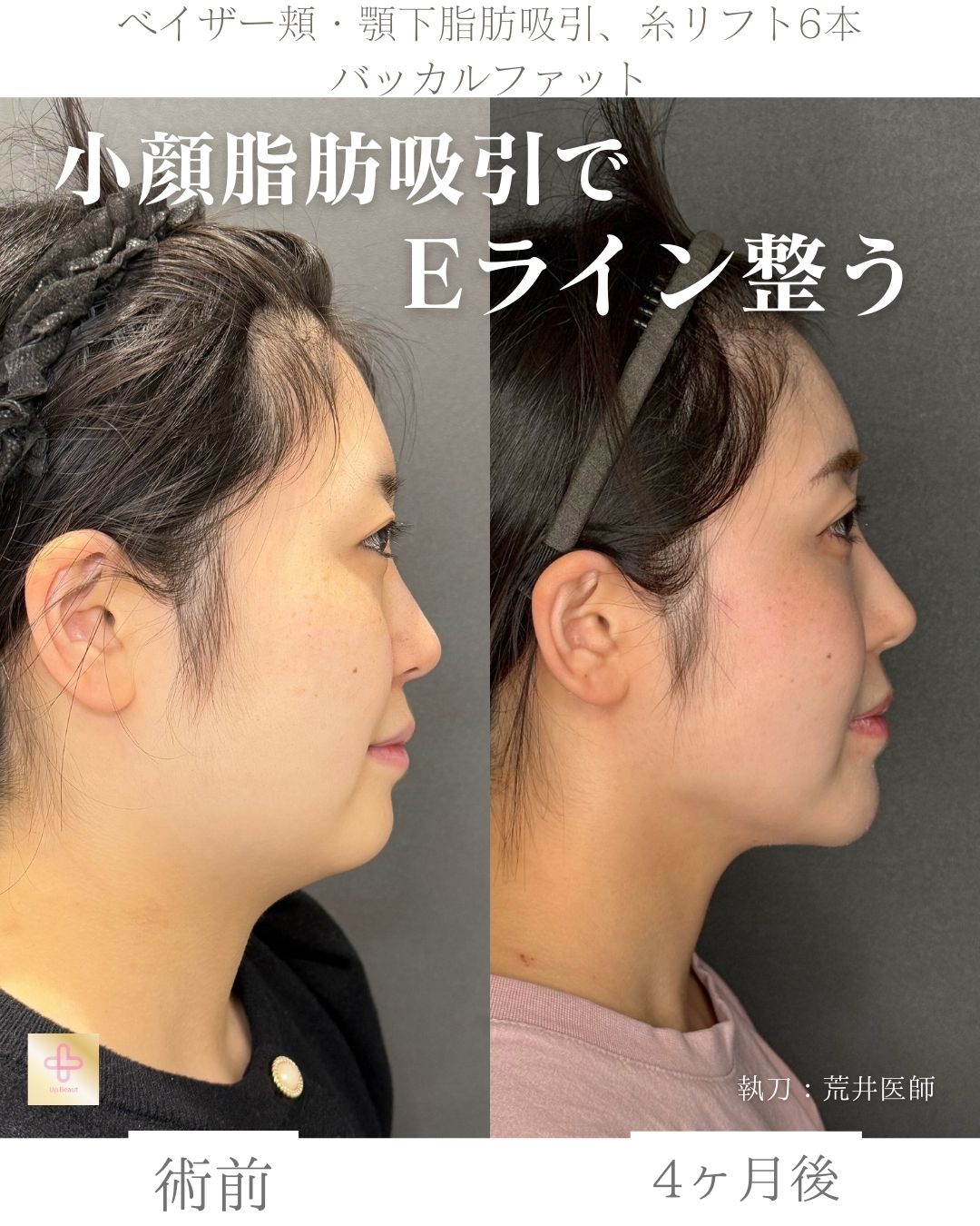 小顔脂肪吸引、バッカルファット、糸リフト