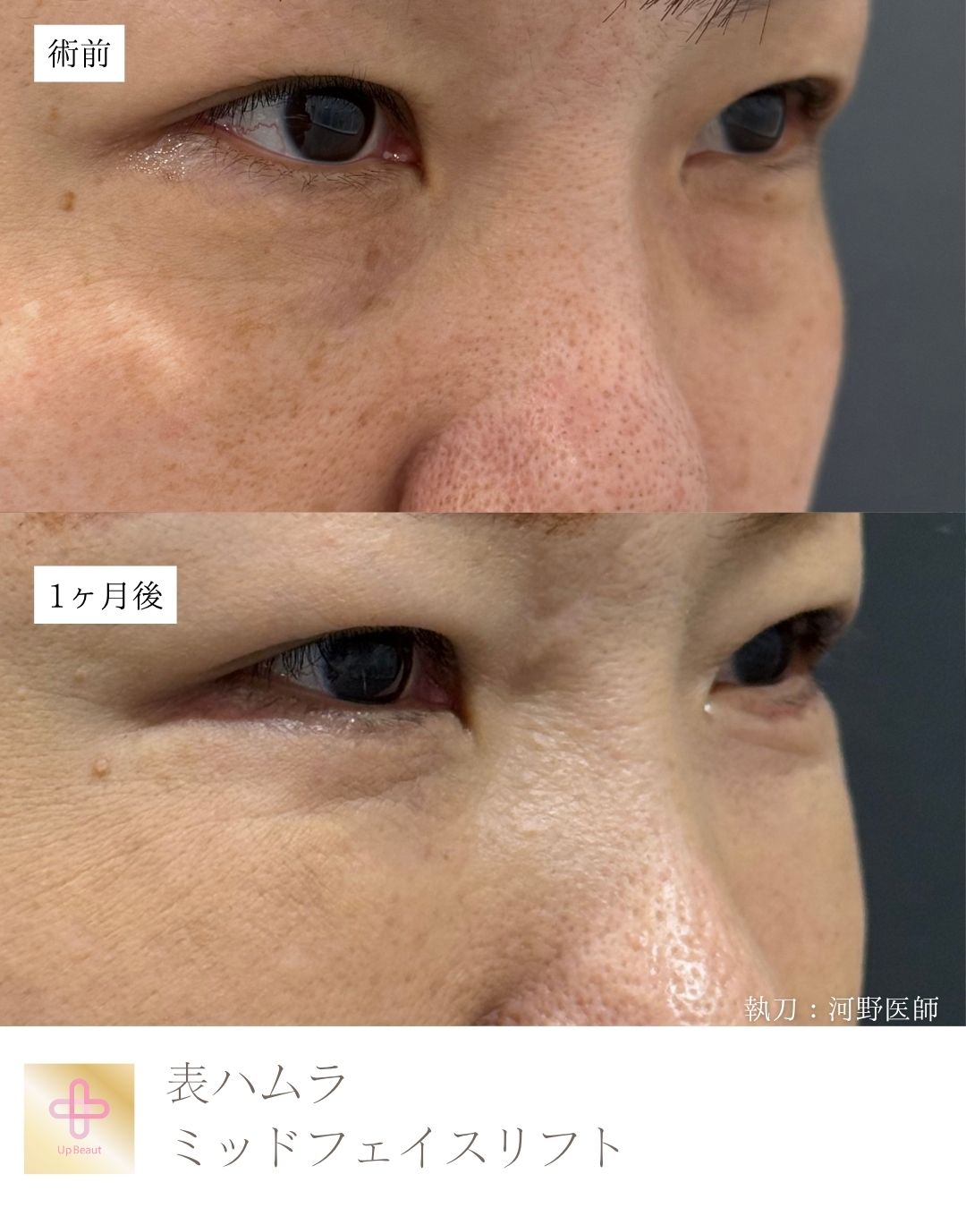 表ハムラ法 ・ミッドフェイスリフト