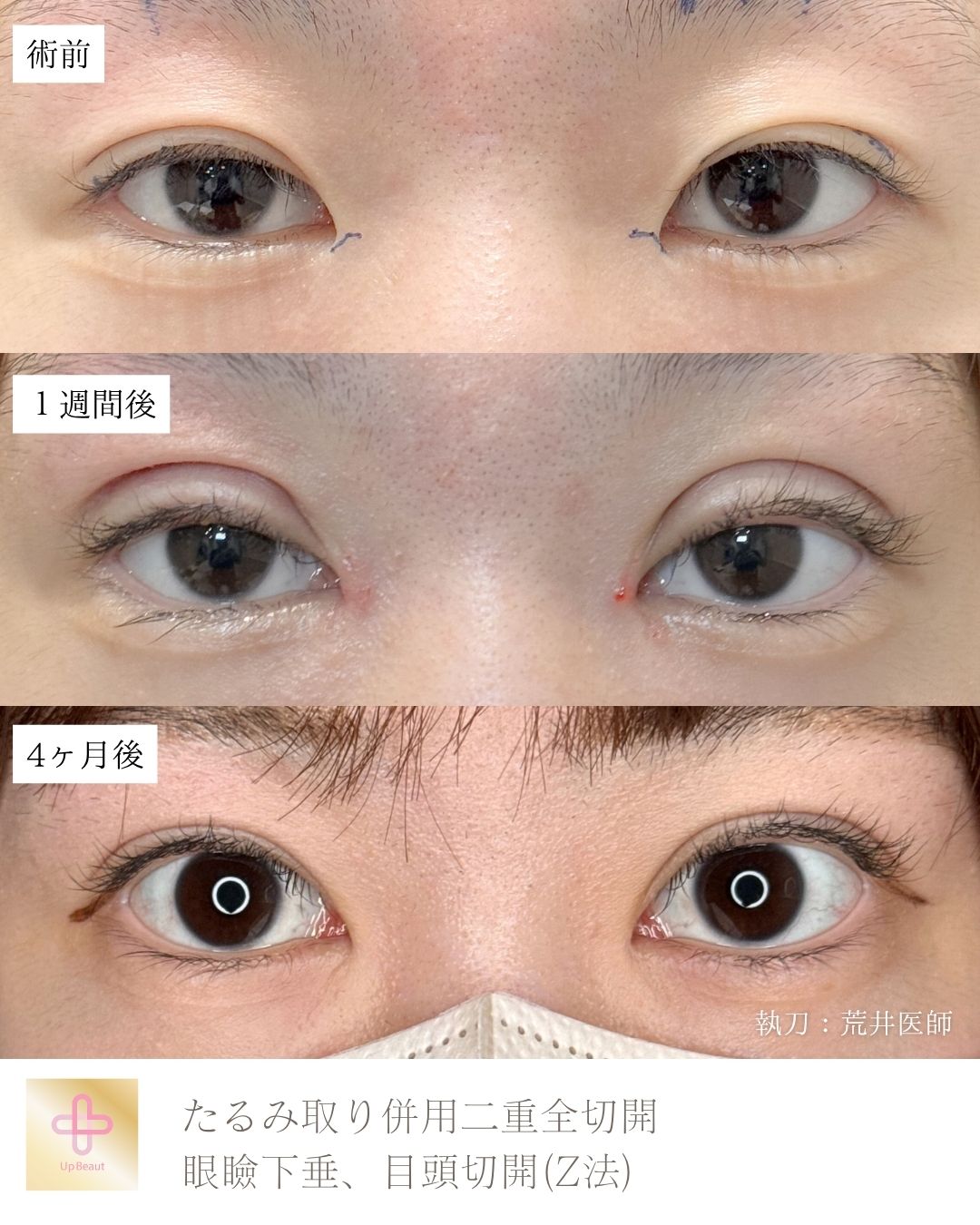 たるみ取り併用全切開二重術、目頭切開(Z法) 、眼瞼下垂