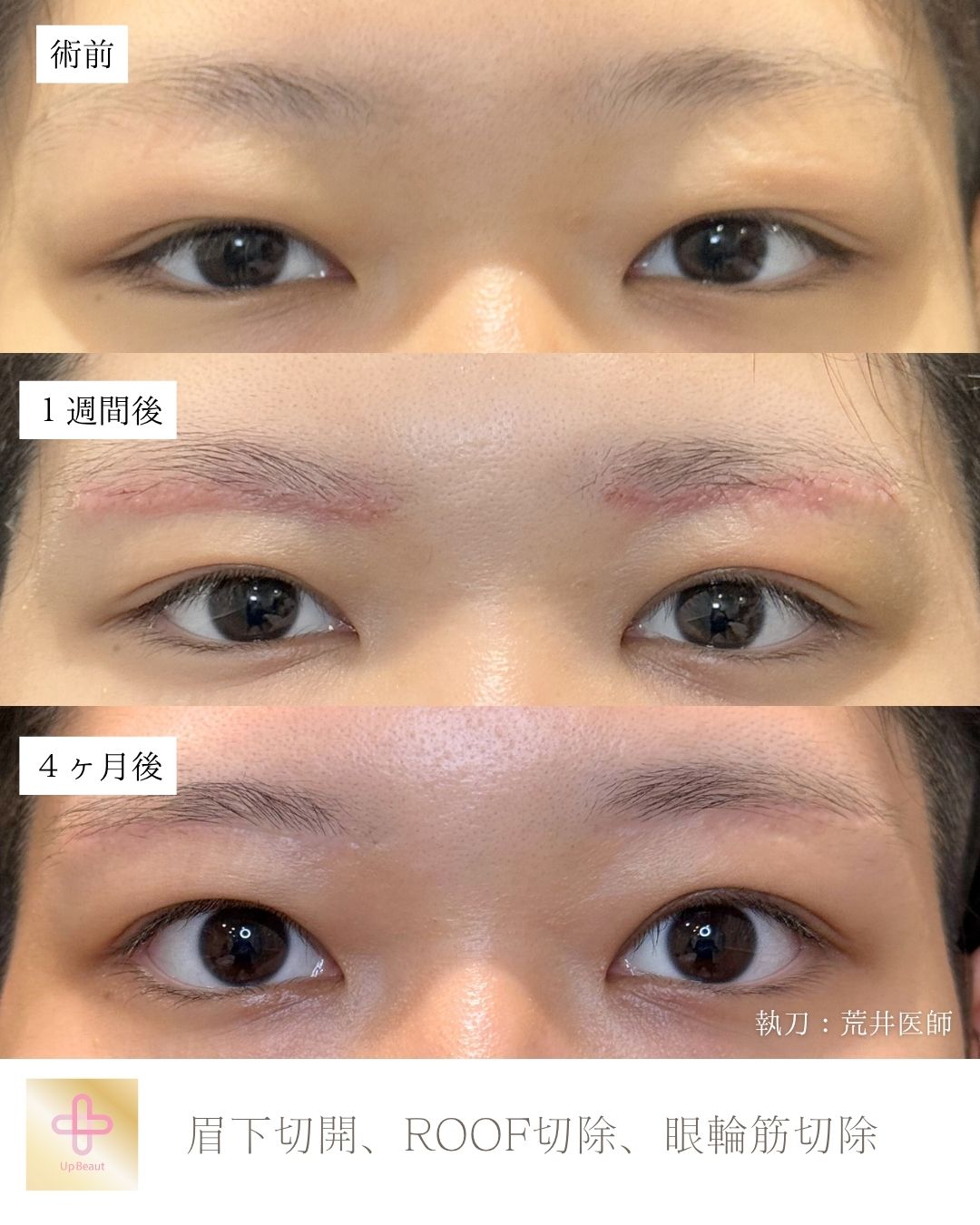 眉下切開、ROOF切除、眼輪筋切除