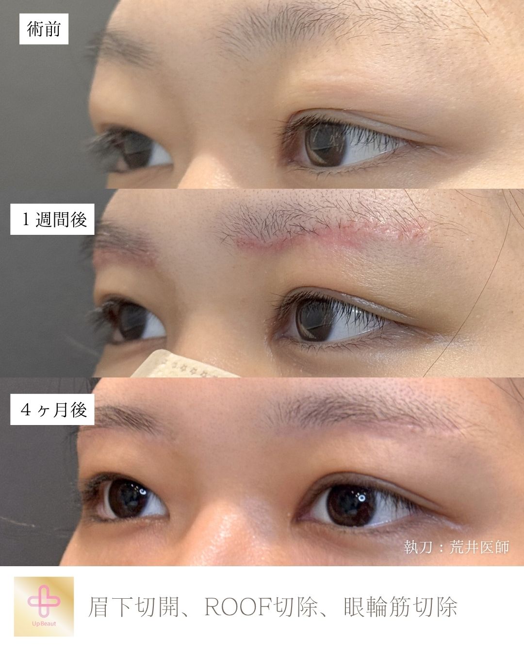 眉下切開、ROOF切除、眼輪筋切除