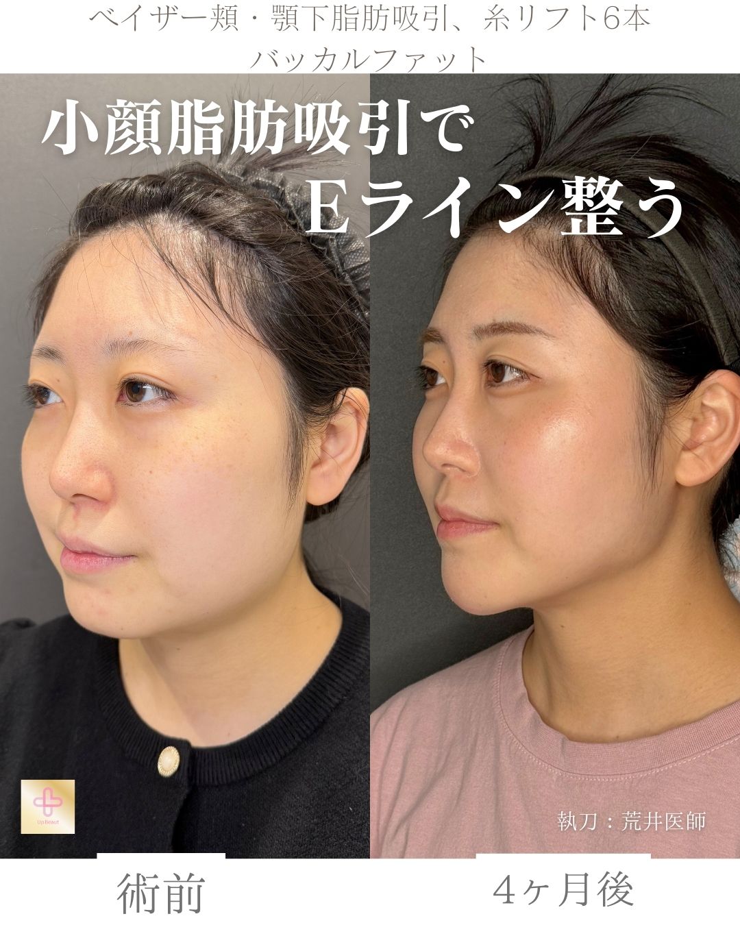 小顔脂肪吸引、バッカルファット、糸リフト