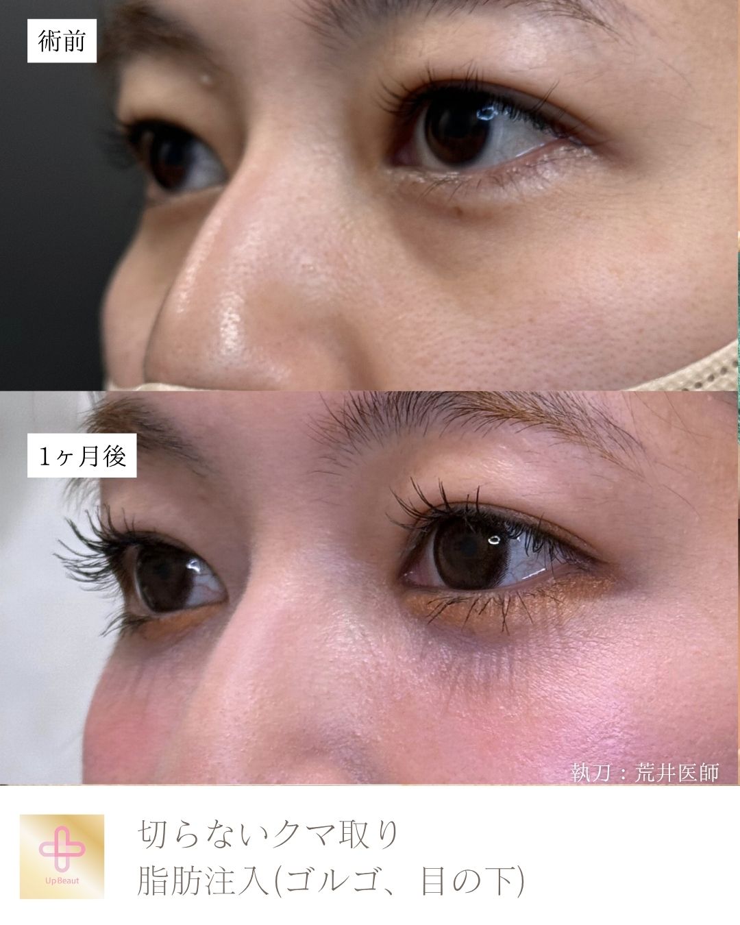 目の下の脱脂、脂肪注入（目の下）