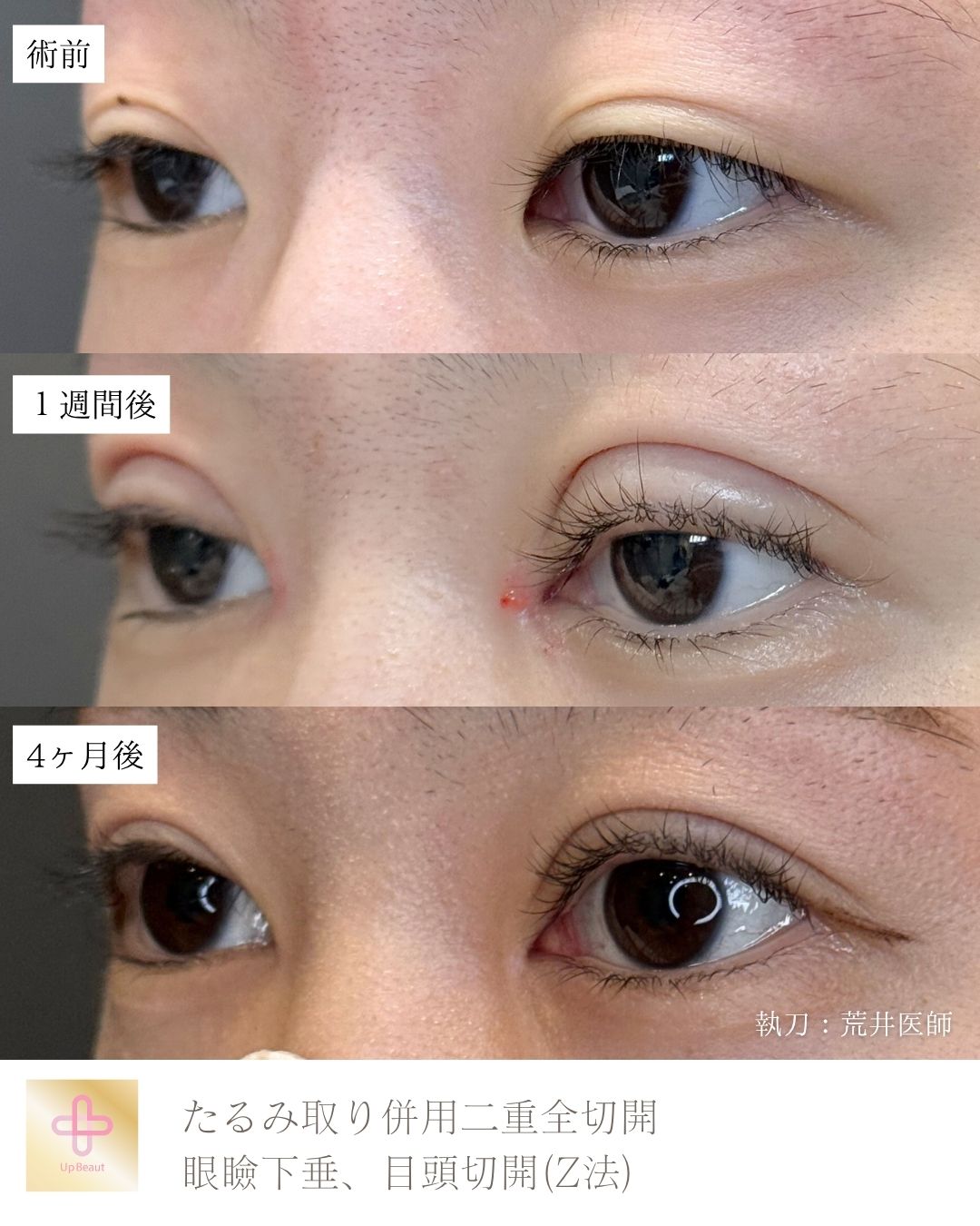 たるみ取り併用全切開二重術、目頭切開(Z法) 、眼瞼下垂