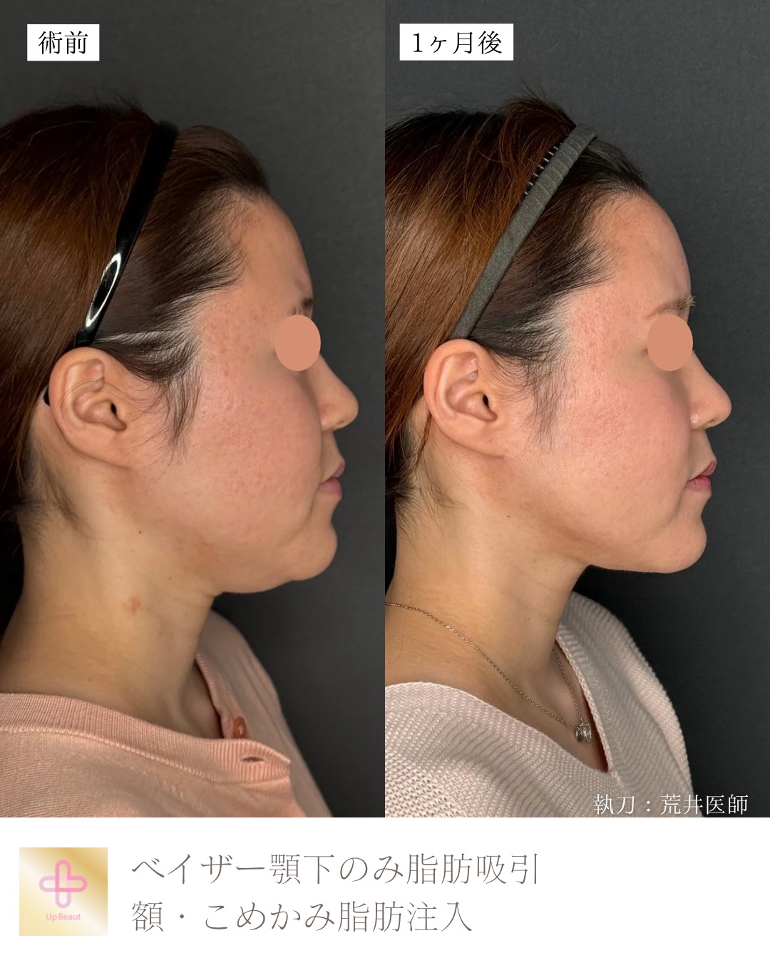 顎下脂肪吸引、頬・こめかみ脂肪注入