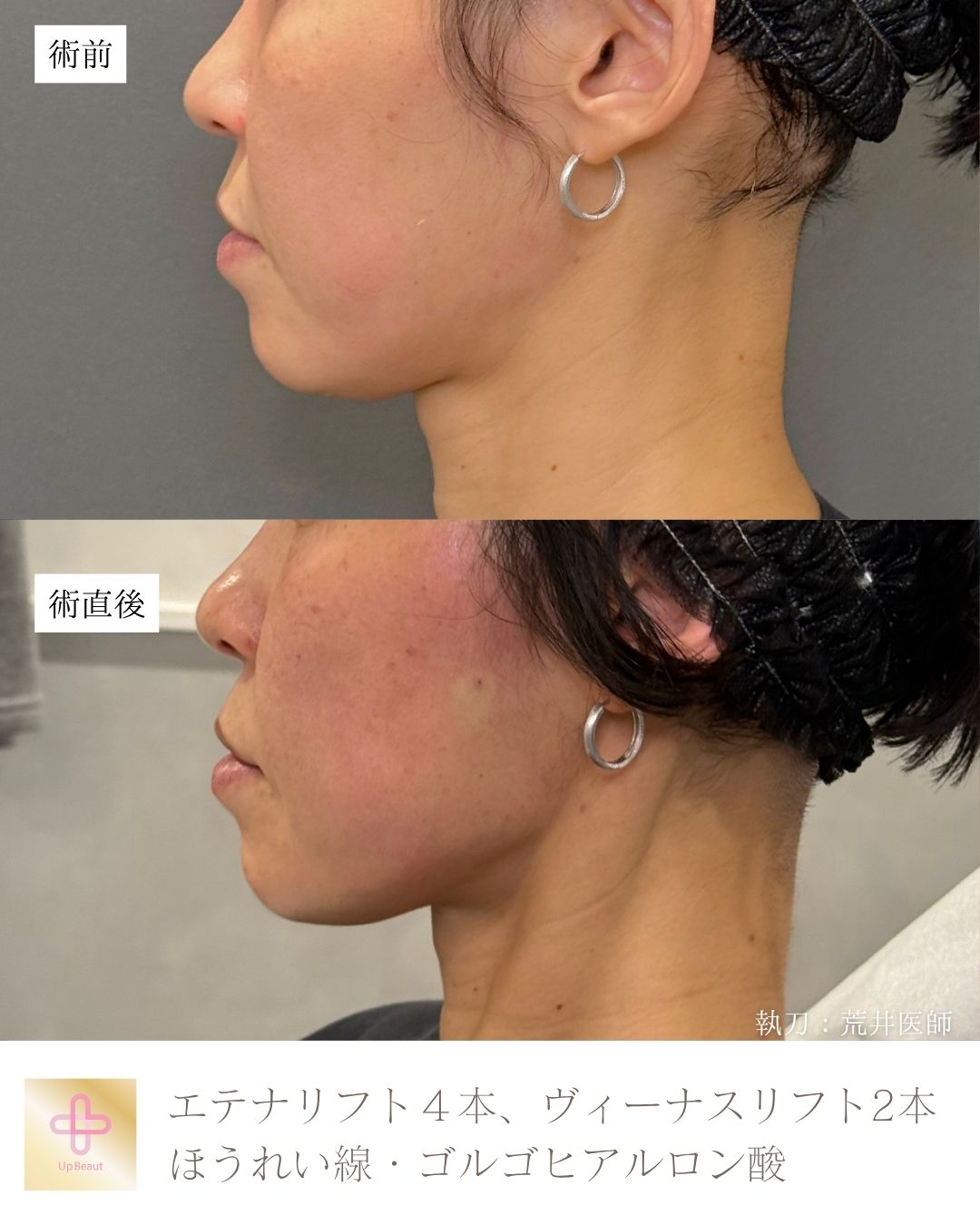 エテナリフト4本、ヴィーナスリフト2本、ゴルゴ・ほうれい線ヒアルロン酸