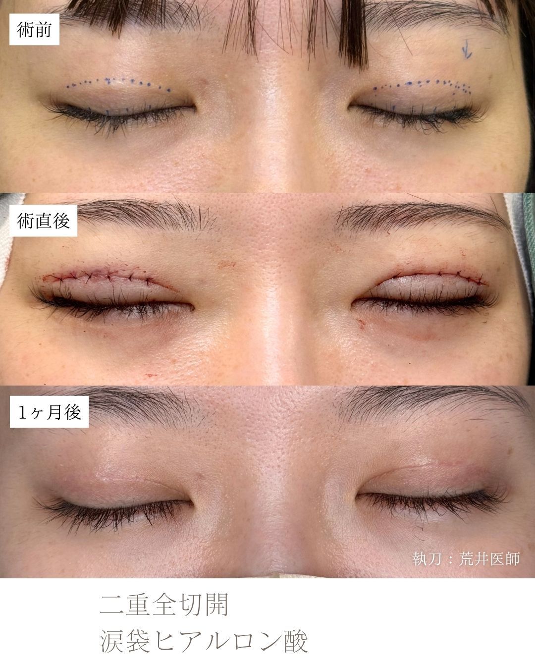 二重全切開　涙袋ヒアルロン酸
