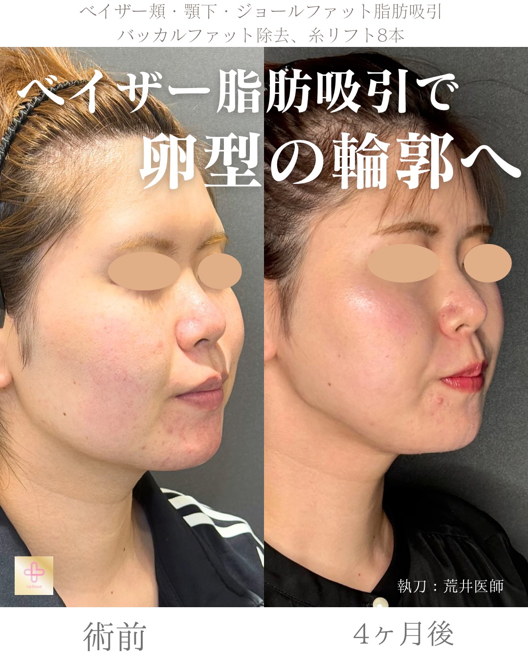 小顔脂肪吸引、ジョールファット、バッカルファット