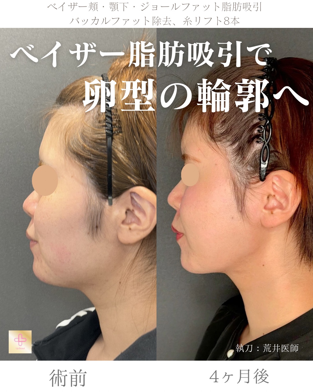 小顔脂肪吸引、ジョールファット、バッカルファット