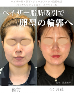 小顔脂肪吸引