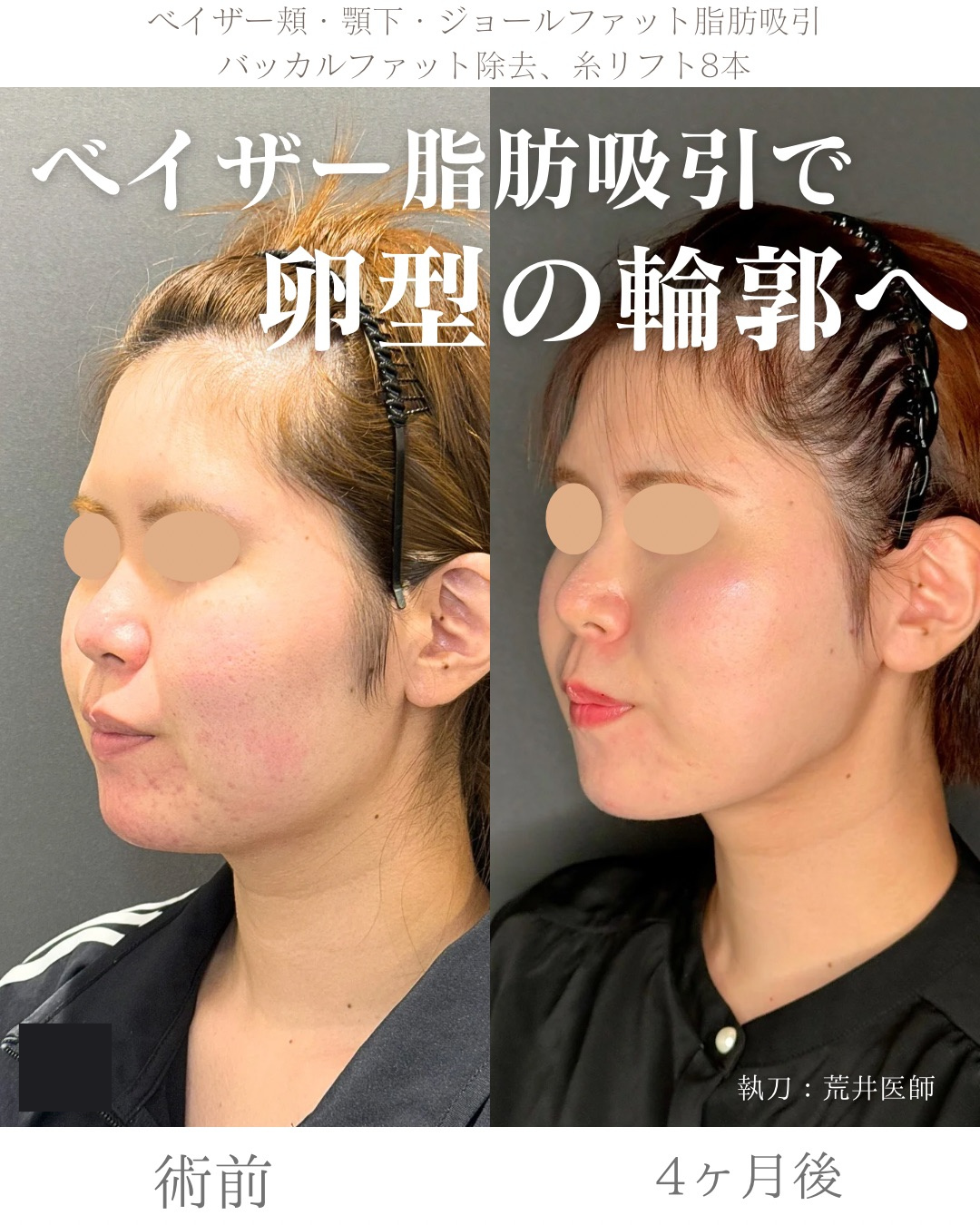 小顔脂肪吸引