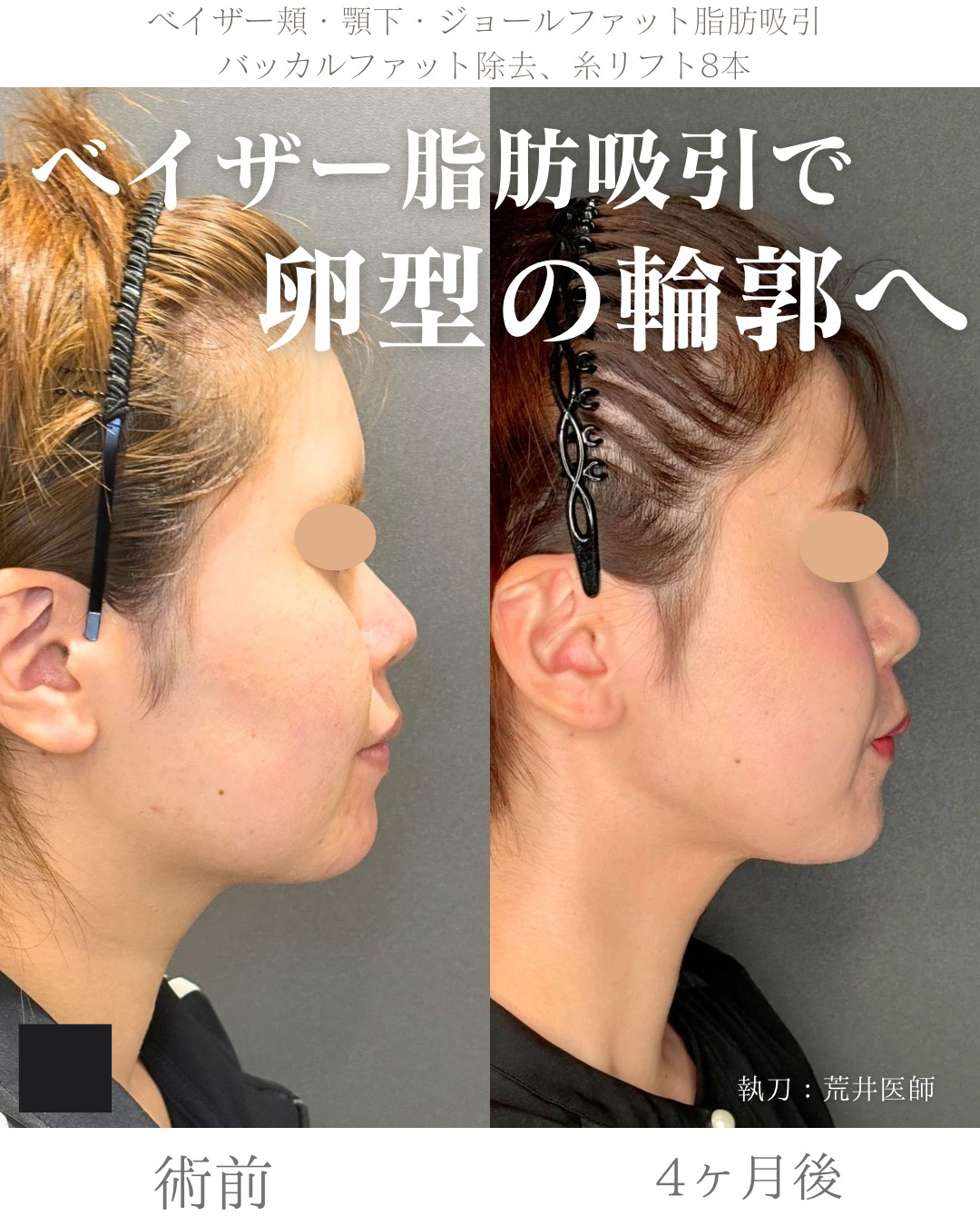 小顔脂肪吸引