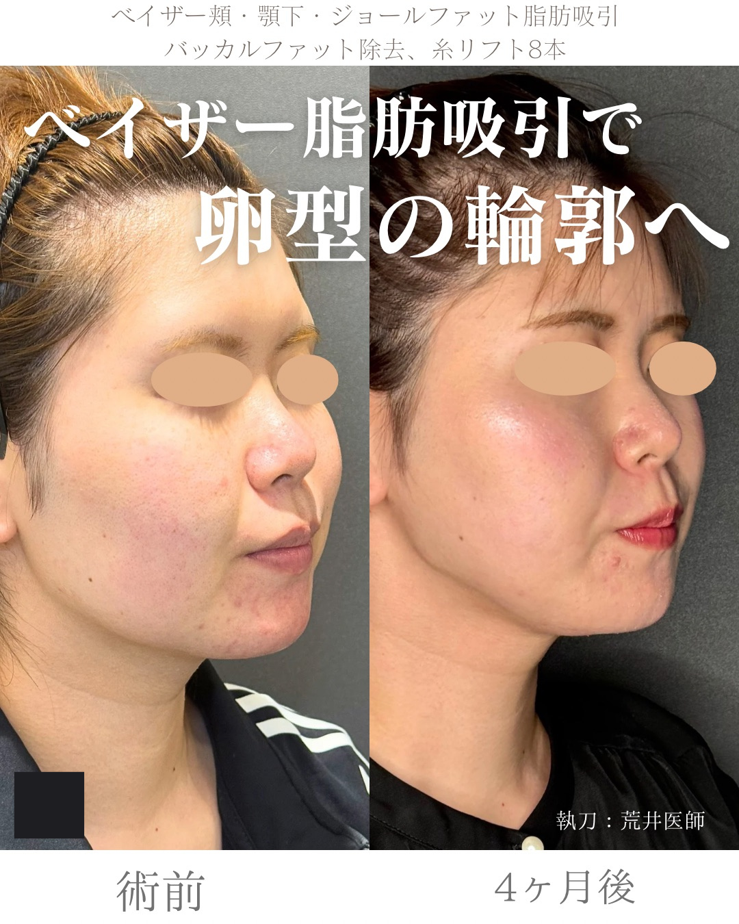 小顔脂肪吸引