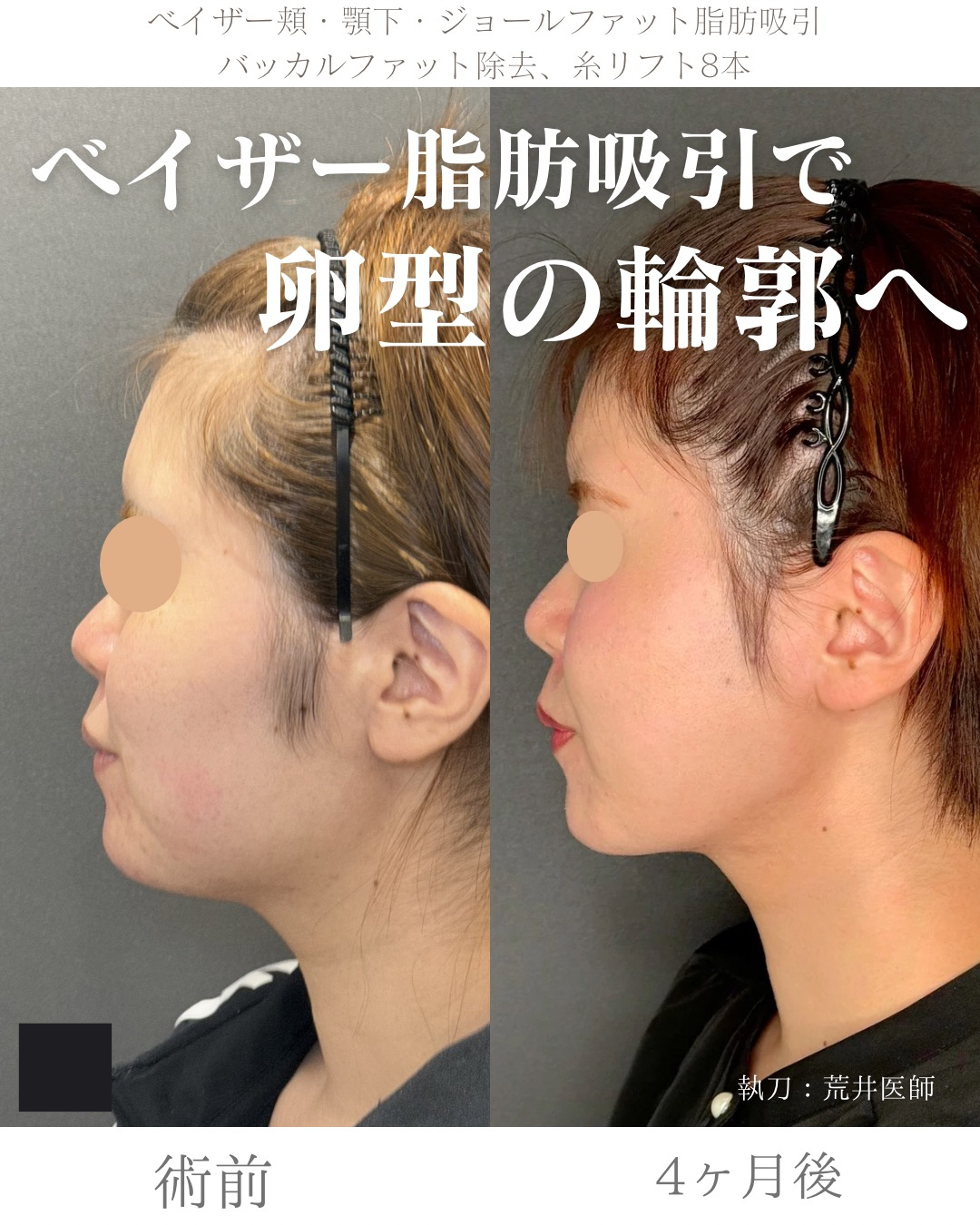 小顔脂肪吸引