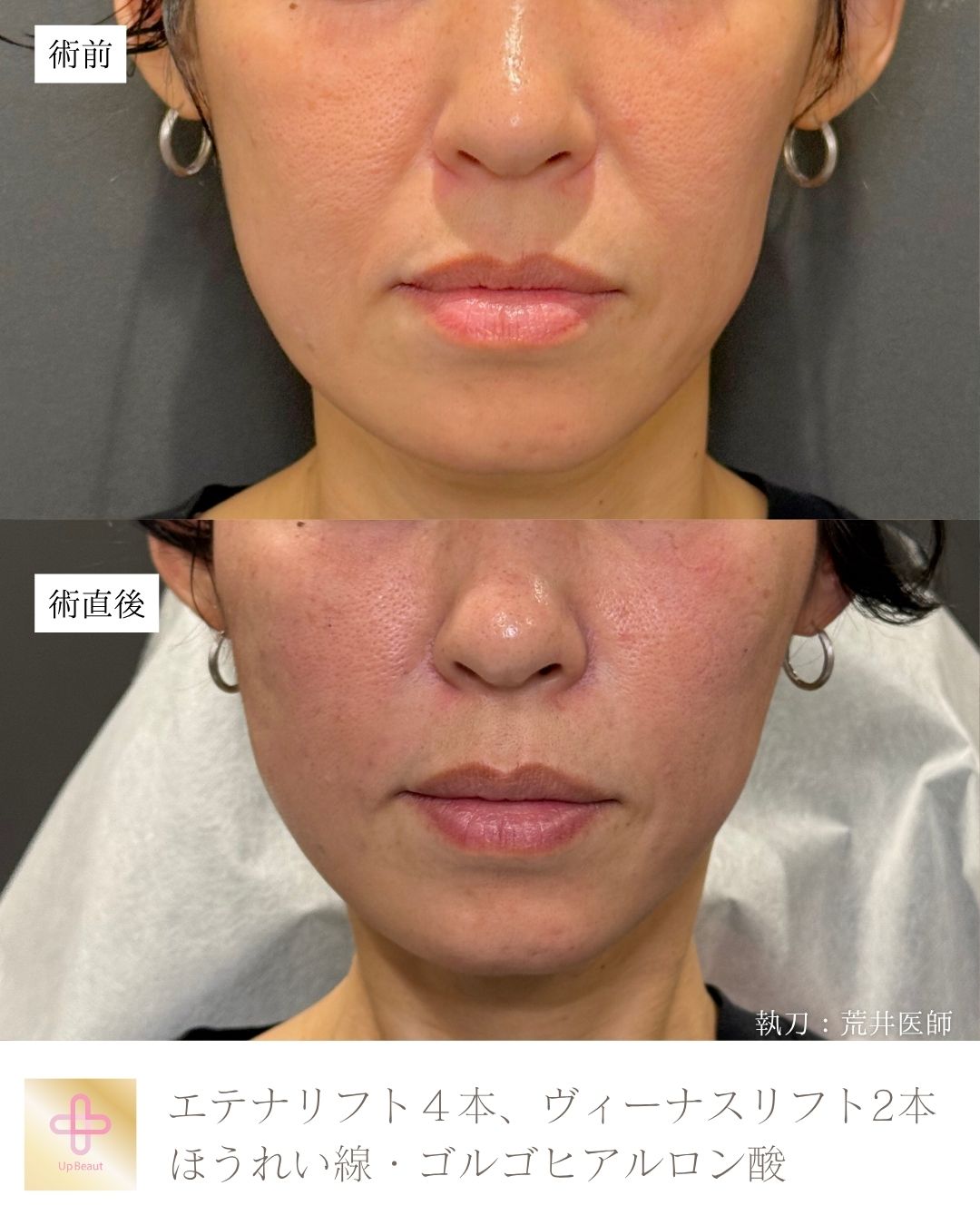 エテナリフト4本、ヴィーナスリフト2本、ゴルゴ・ほうれい線ヒアルロン酸