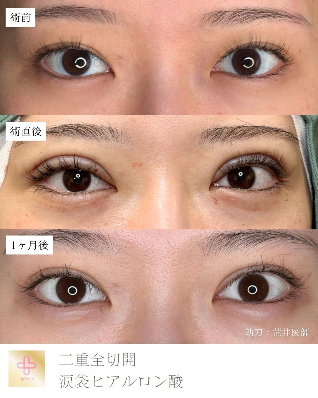 たるみ取り併用全切開二重術　涙袋ヒアルロン酸
