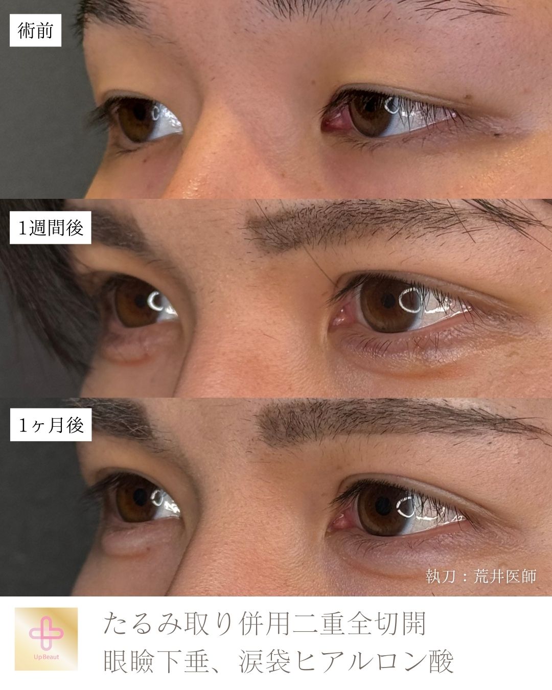 たるみ取り併用全切開二重術、眼瞼下垂