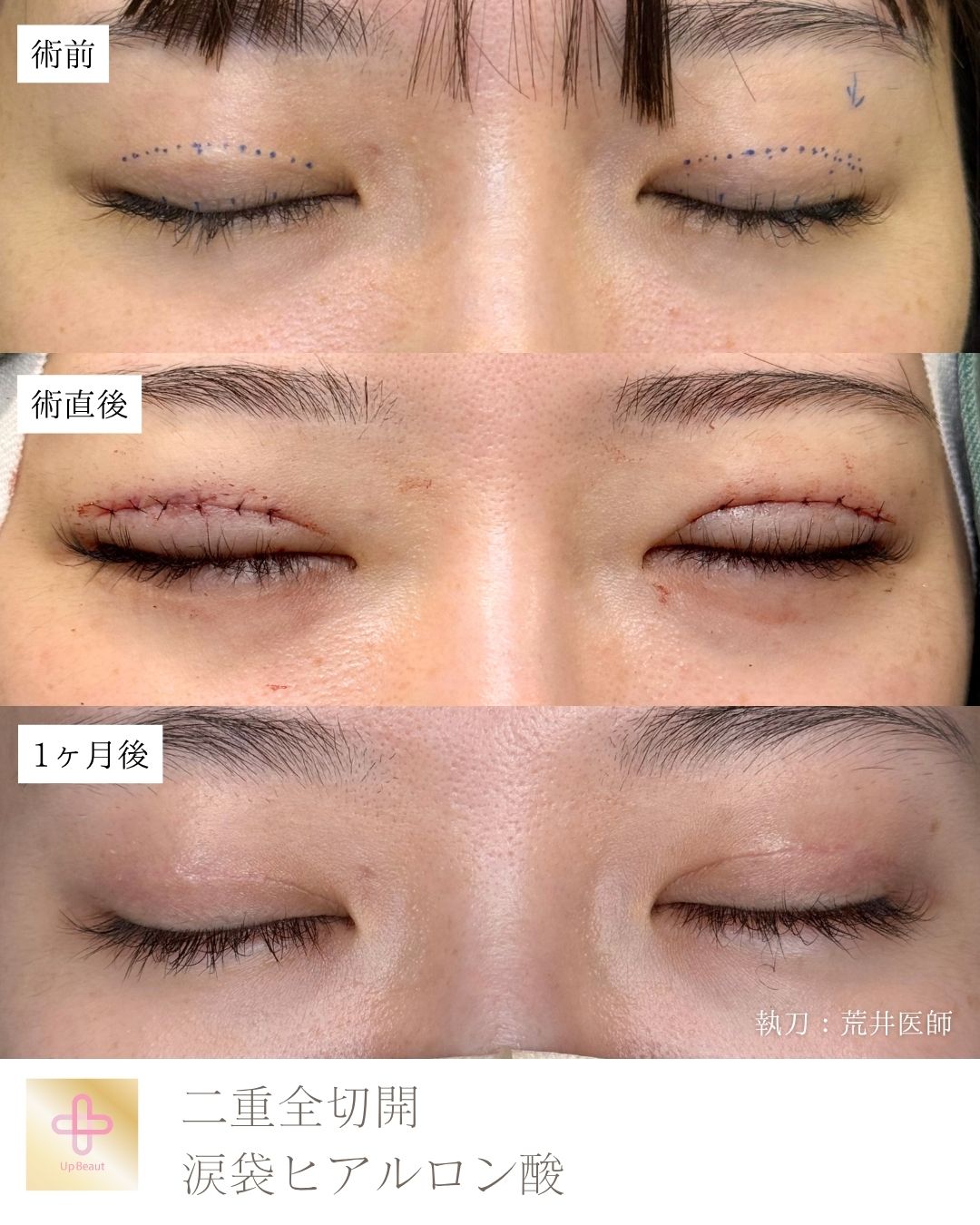 たるみ取り併用全切開二重術　涙袋ヒアルロン酸