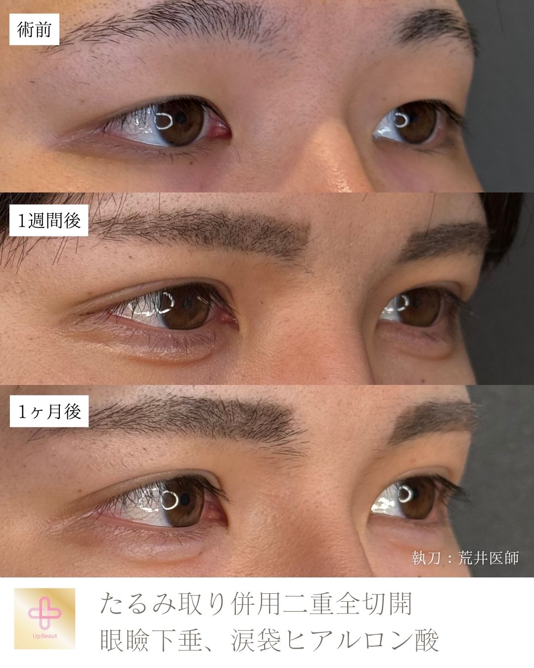 たるみ取り併用全切開二重術、眼瞼下垂