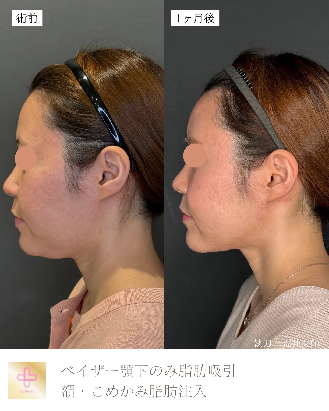 顎下脂肪吸引、頬・こめかみ脂肪注入