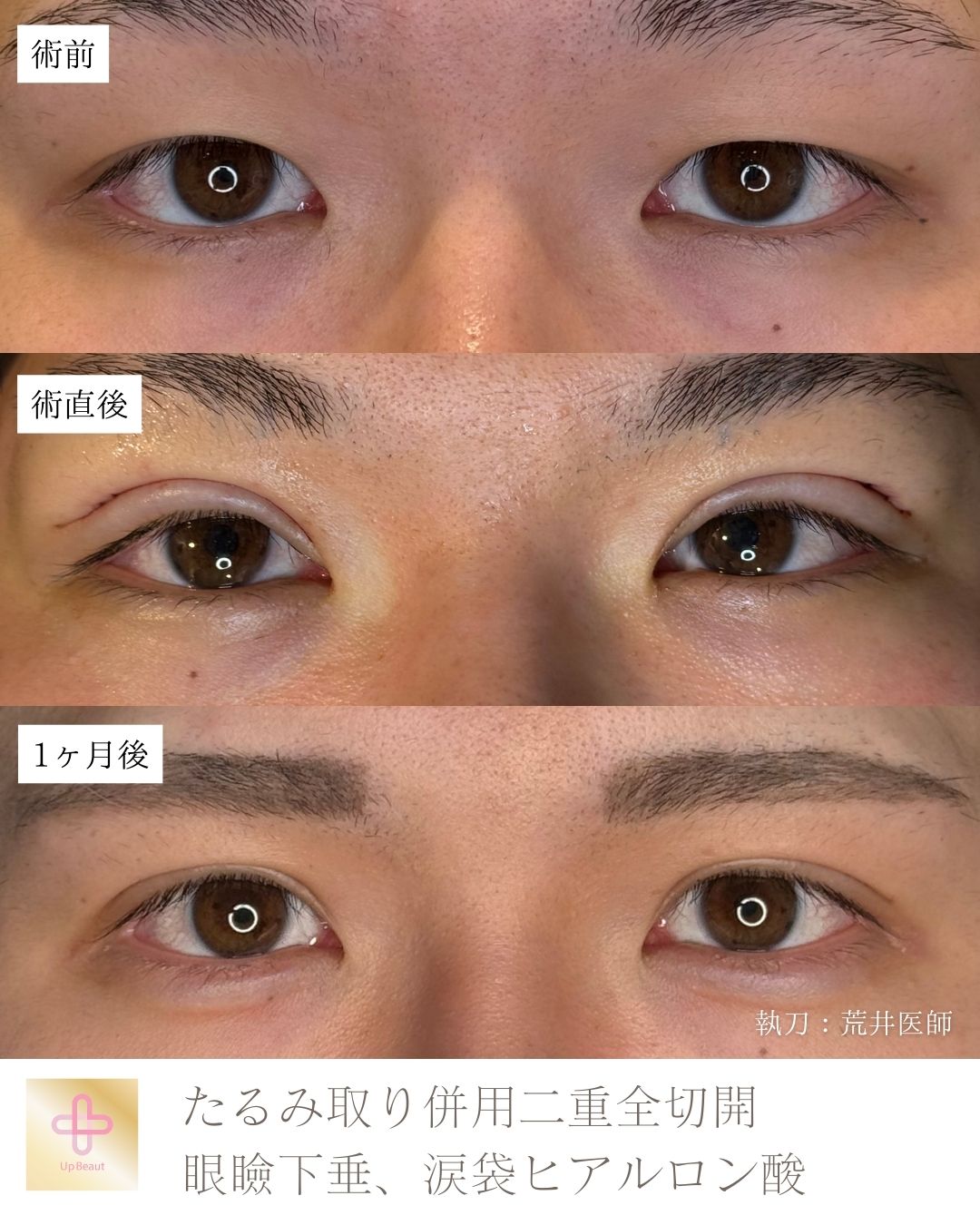 たるみ取り併用全切開二重術、眼瞼下垂