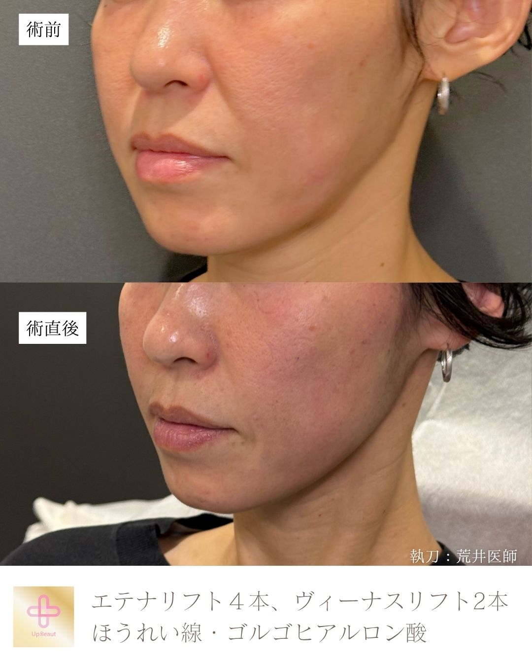 エテナリフト4本、ヴィーナスリフト2本、ゴルゴ・ほうれい線ヒアルロン酸