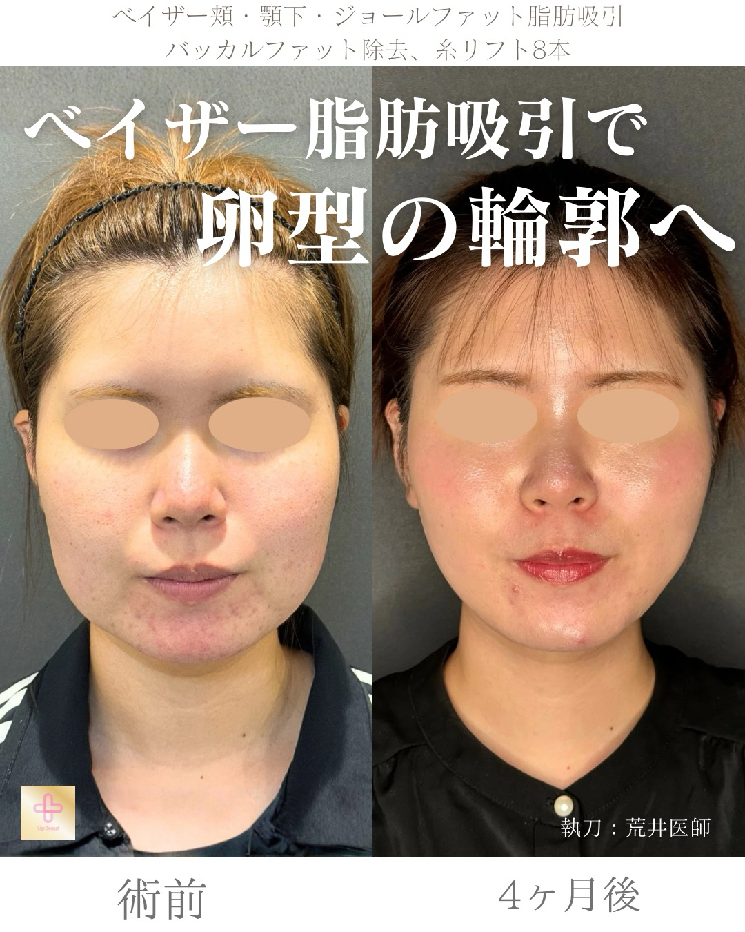 小顔脂肪吸引、ジョールファット、バッカルファット