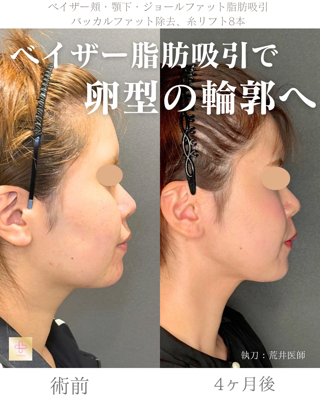 小顔脂肪吸引、ジョールファット、バッカルファット