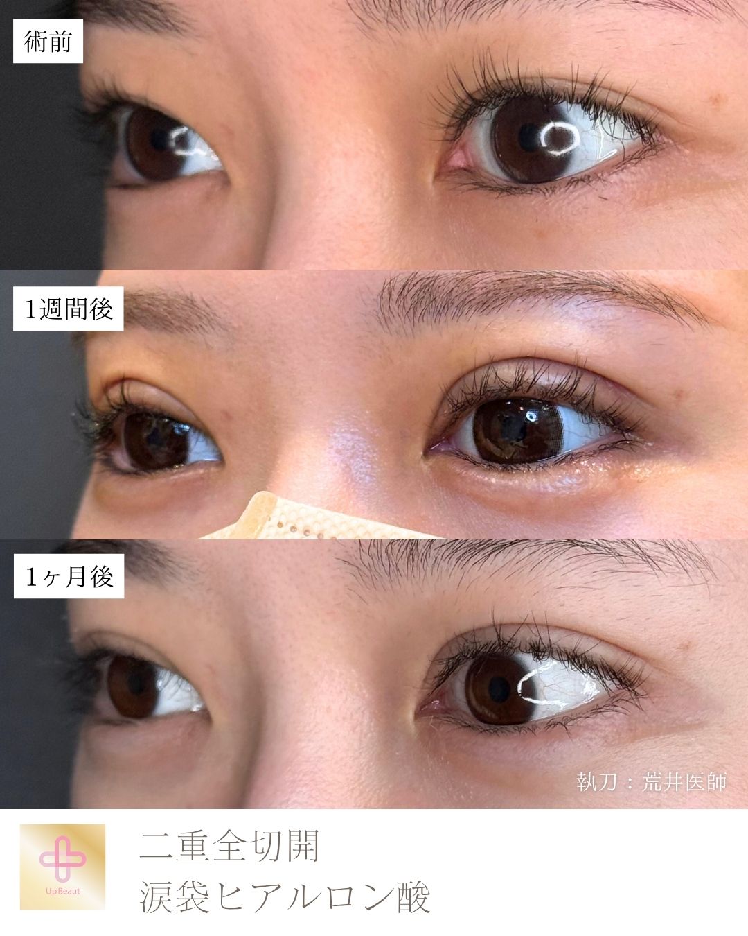 たるみ取り併用全切開二重術　涙袋ヒアルロン酸