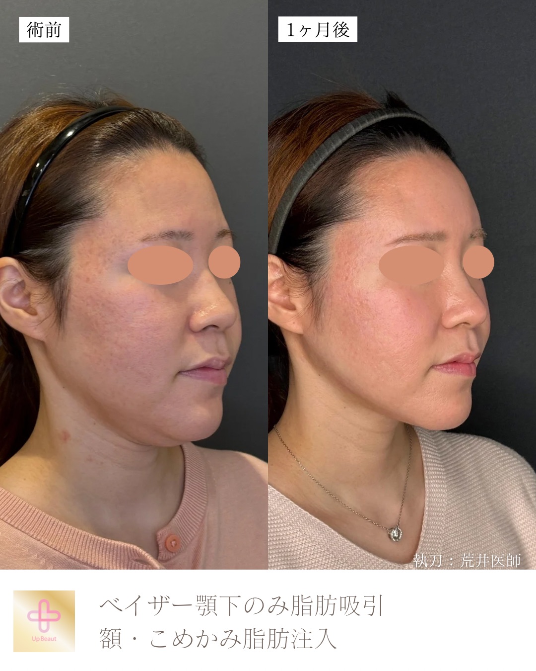 顎下脂肪吸引、頬・こめかみ脂肪注入
