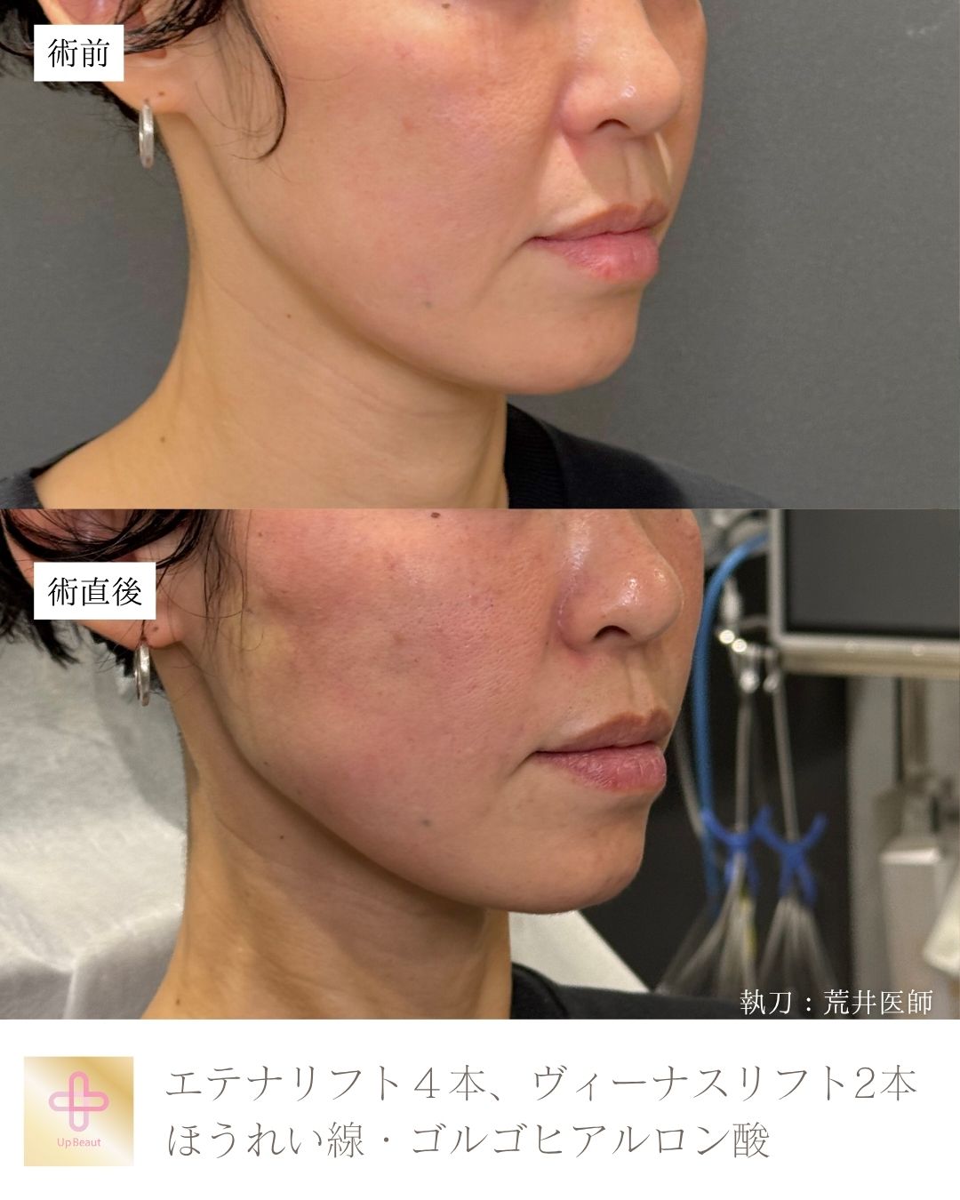 エテナリフト4本、ヴィーナスリフト2本、ゴルゴ・ほうれい線ヒアルロン酸