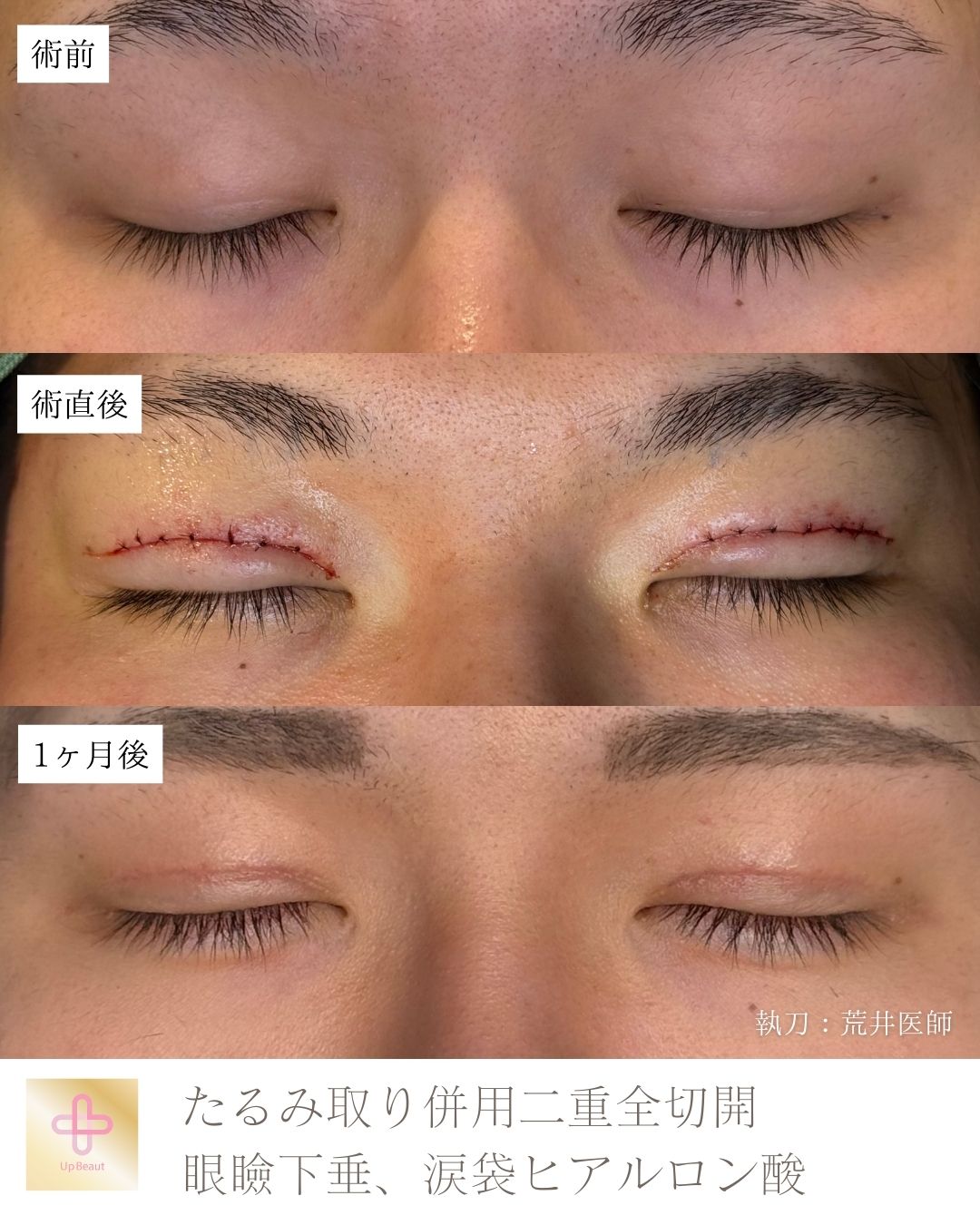 たるみ取り併用全切開二重術、眼瞼下垂