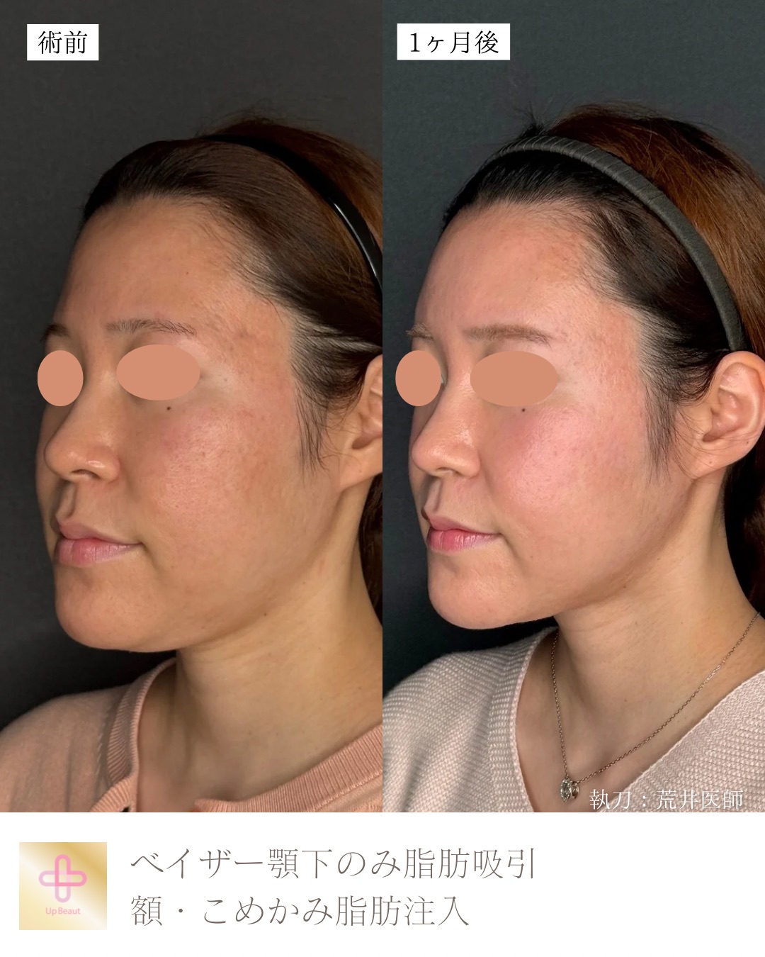 顎下脂肪吸引、頬・こめかみ脂肪注入