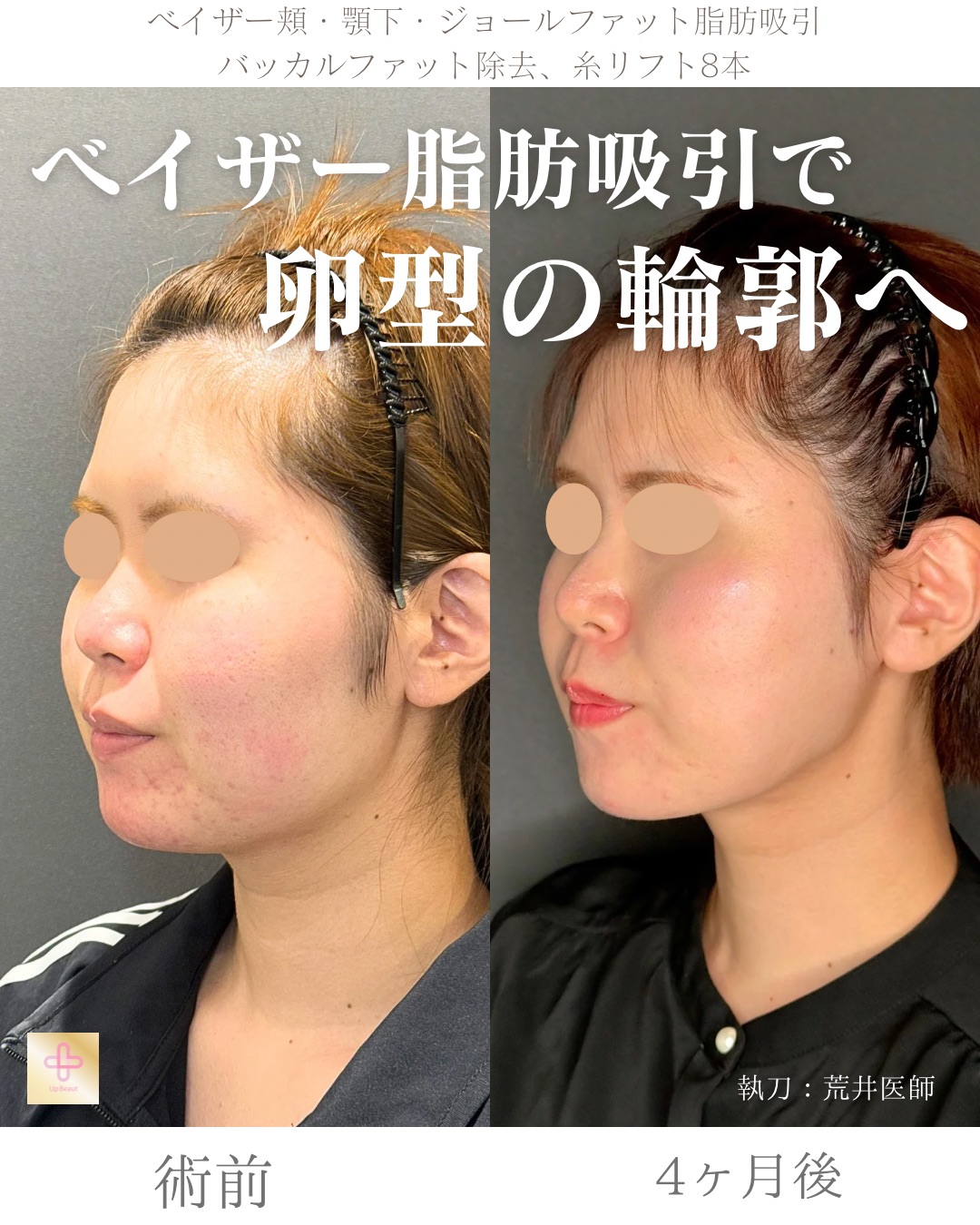 小顔脂肪吸引、ジョールファット、バッカルファット