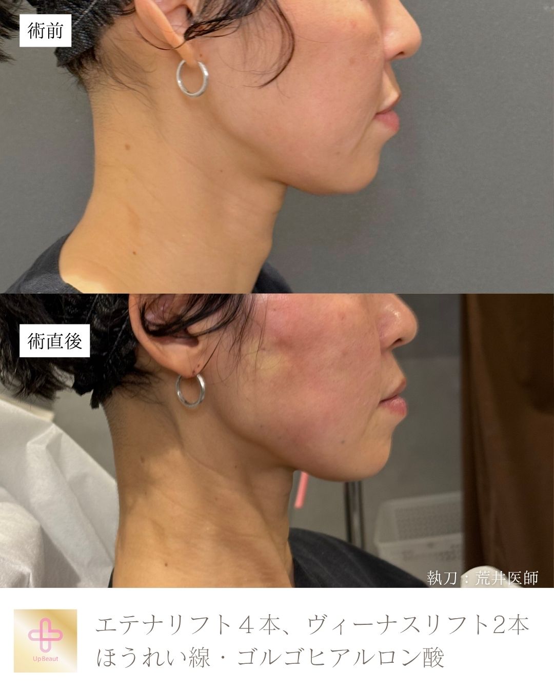 エテナリフト4本、ヴィーナスリフト2本、ゴルゴ・ほうれい線ヒアルロン酸