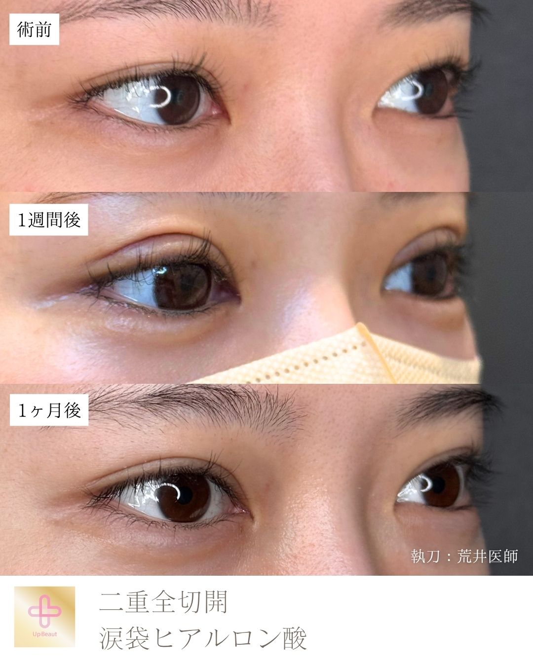 たるみ取り併用全切開二重術　涙袋ヒアルロン酸