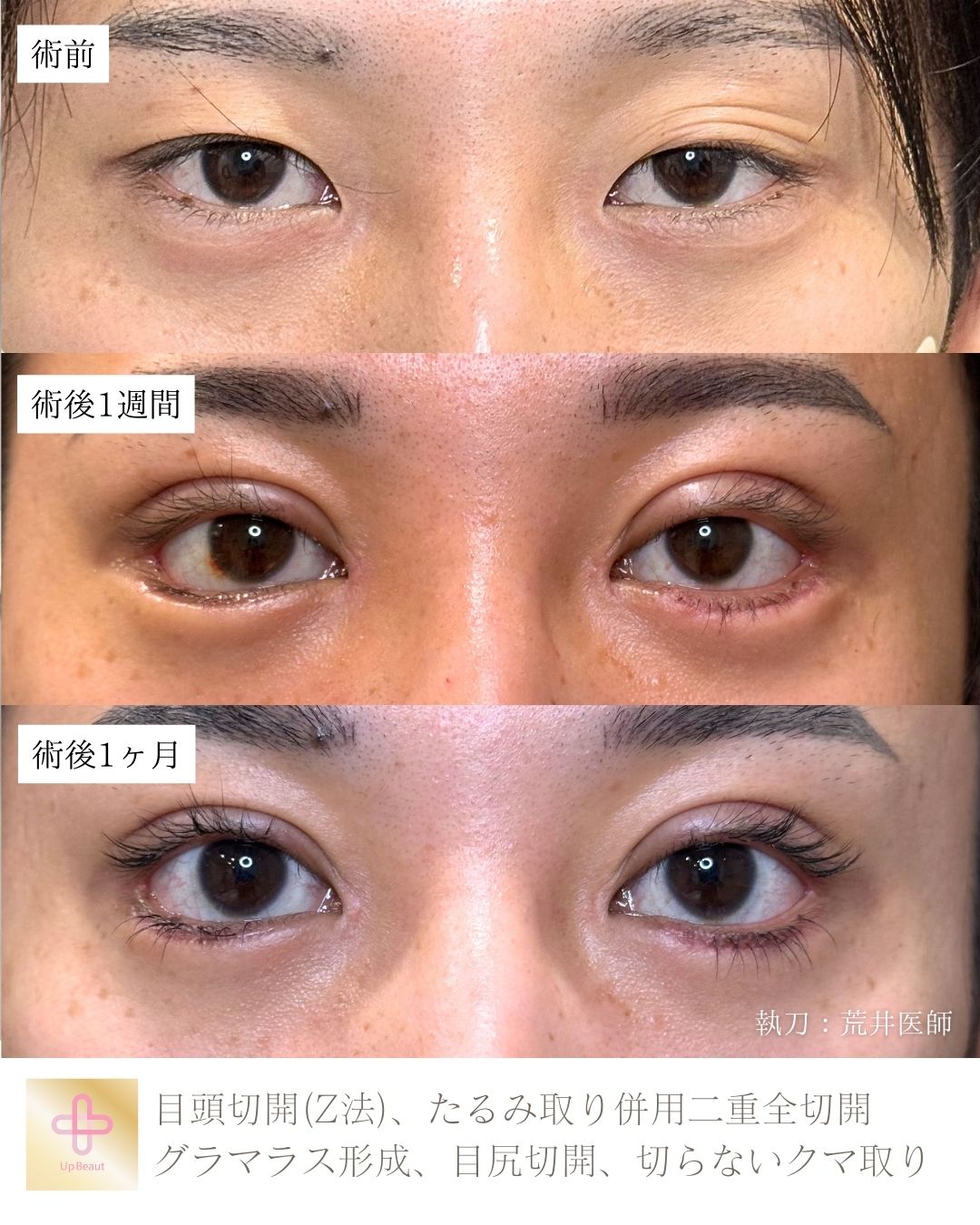 目頭切開,たるみ取り併用二重全切開、グラマラス形成、目尻切開、切らないクマ取り