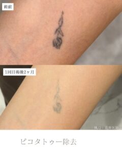 タトゥー除去
