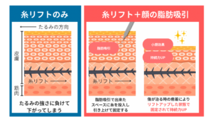 サクションリフト