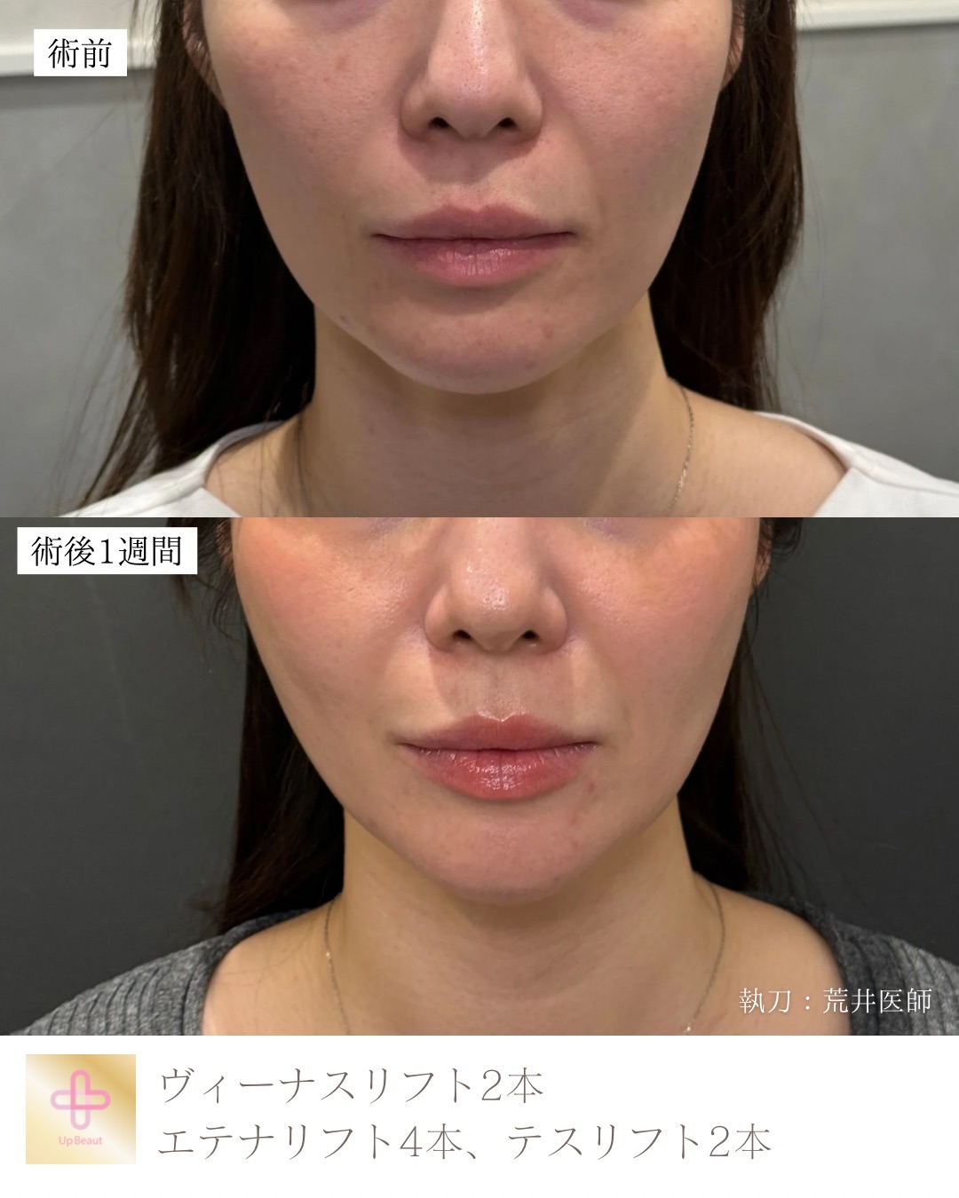 ヴィーナスリフト2本、エテナリフト4本、テスリフト2本