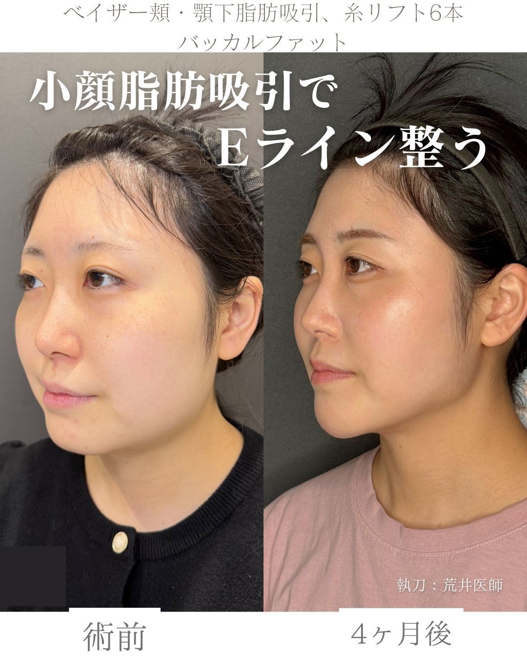 小顔脂肪吸引