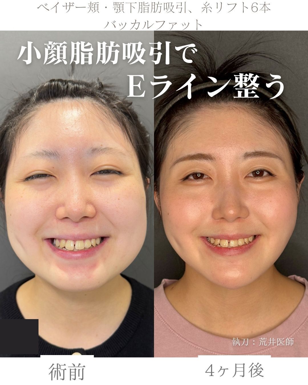 小顔脂肪吸引